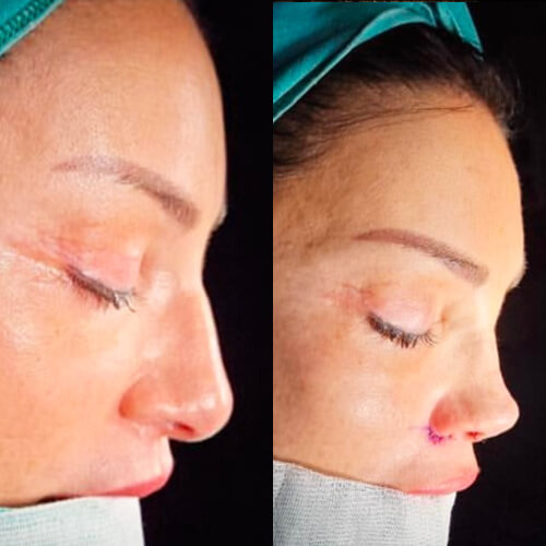 rhinoplasty before and after turkey