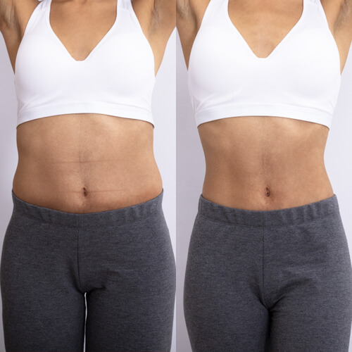 liposuction before after istanbul