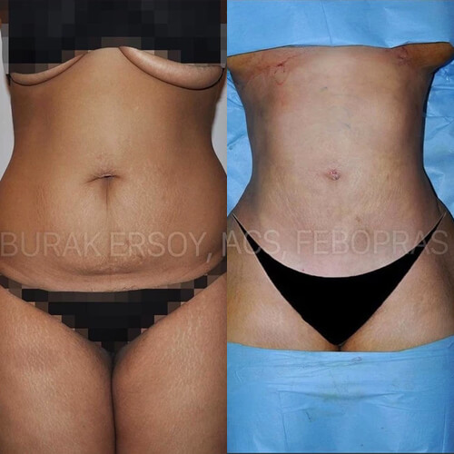 liposuction before after turkey