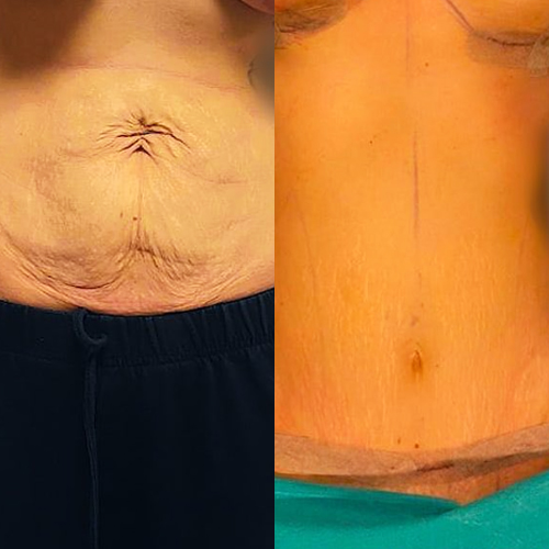 tummy-tuck-turkey-before-after