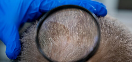 dhi-hair-transplant-safe-in-turkey