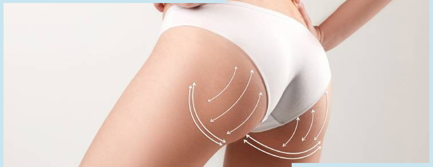 recovery-after-buttock-augmentation-with-fat-transfer-2