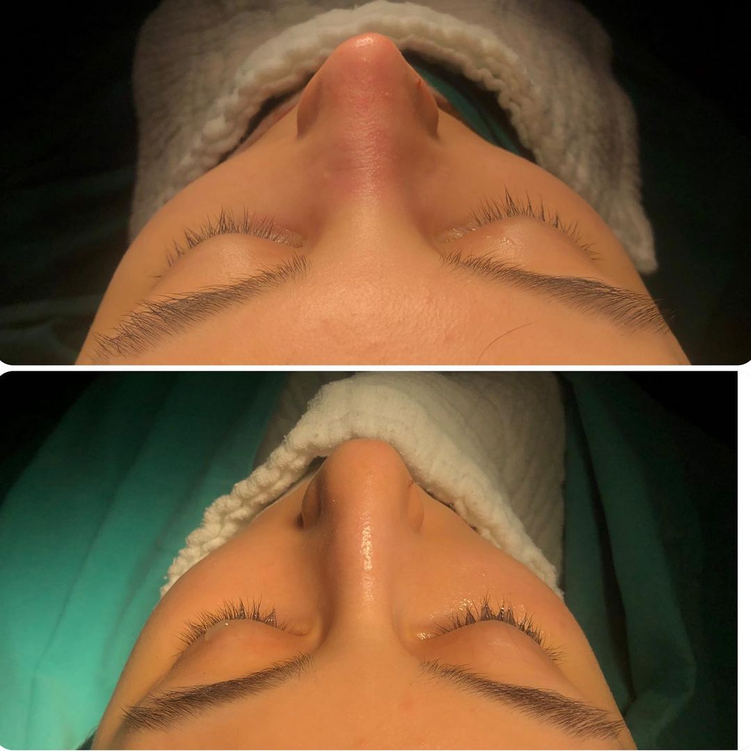 before and after rhinoplasty female