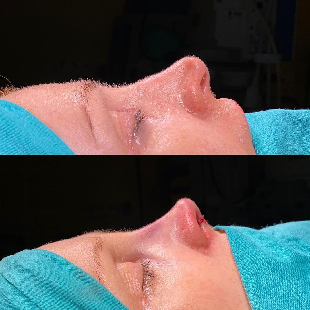 before and after rhinoplasty in Turkey