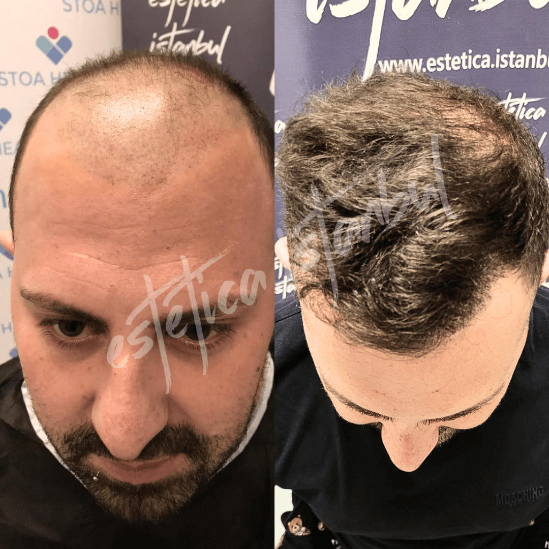 hair transplant post op Turkey