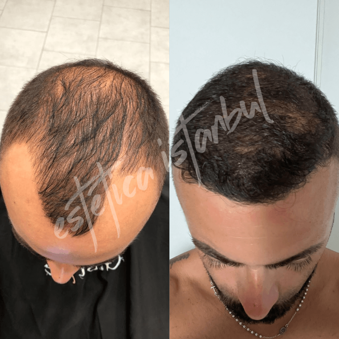 hair transplant for men before after