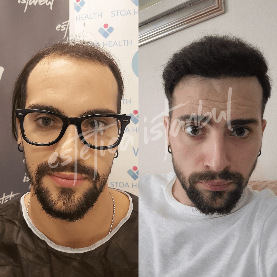 hair transplant for men before after Turkey
