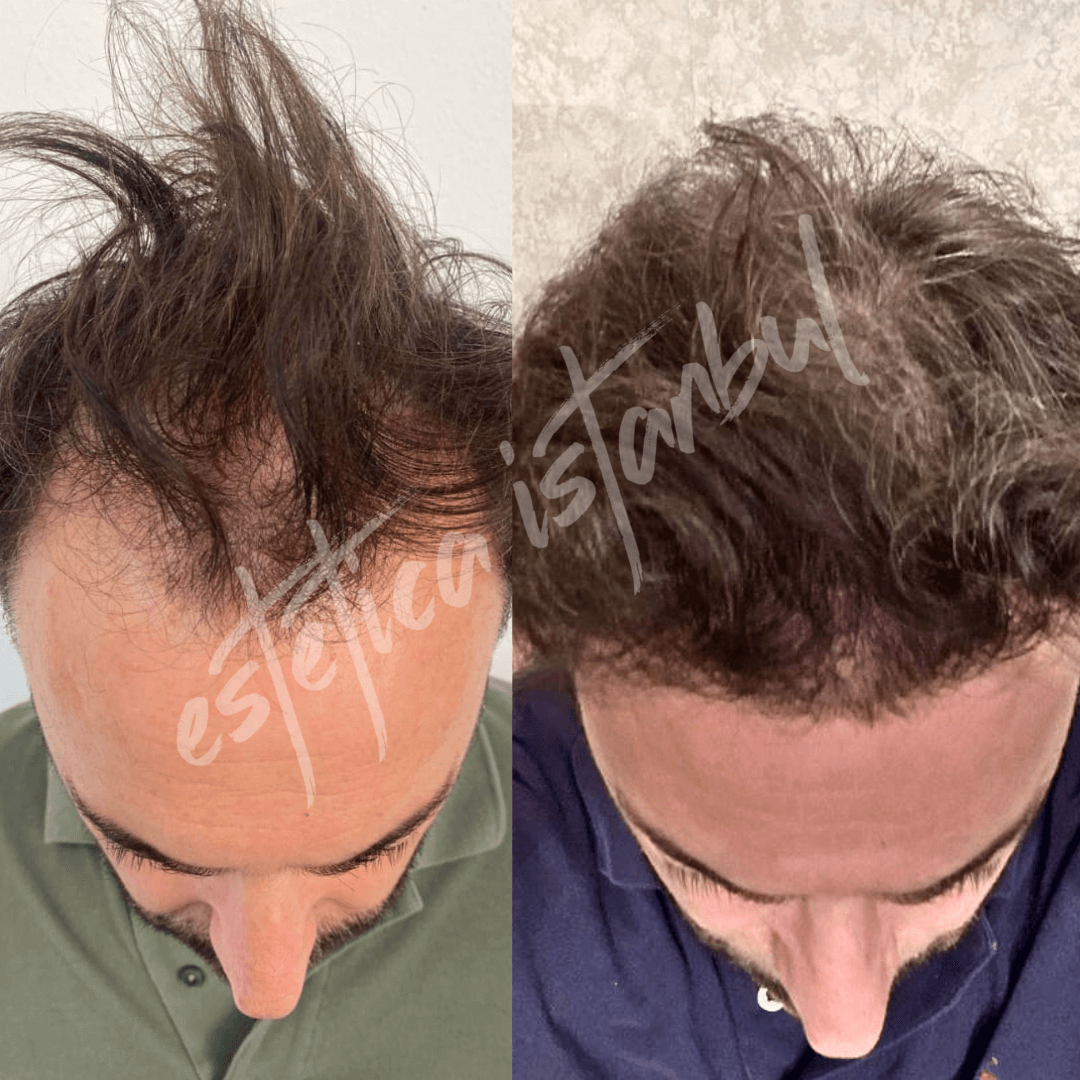 hair transplant in turkey before and after