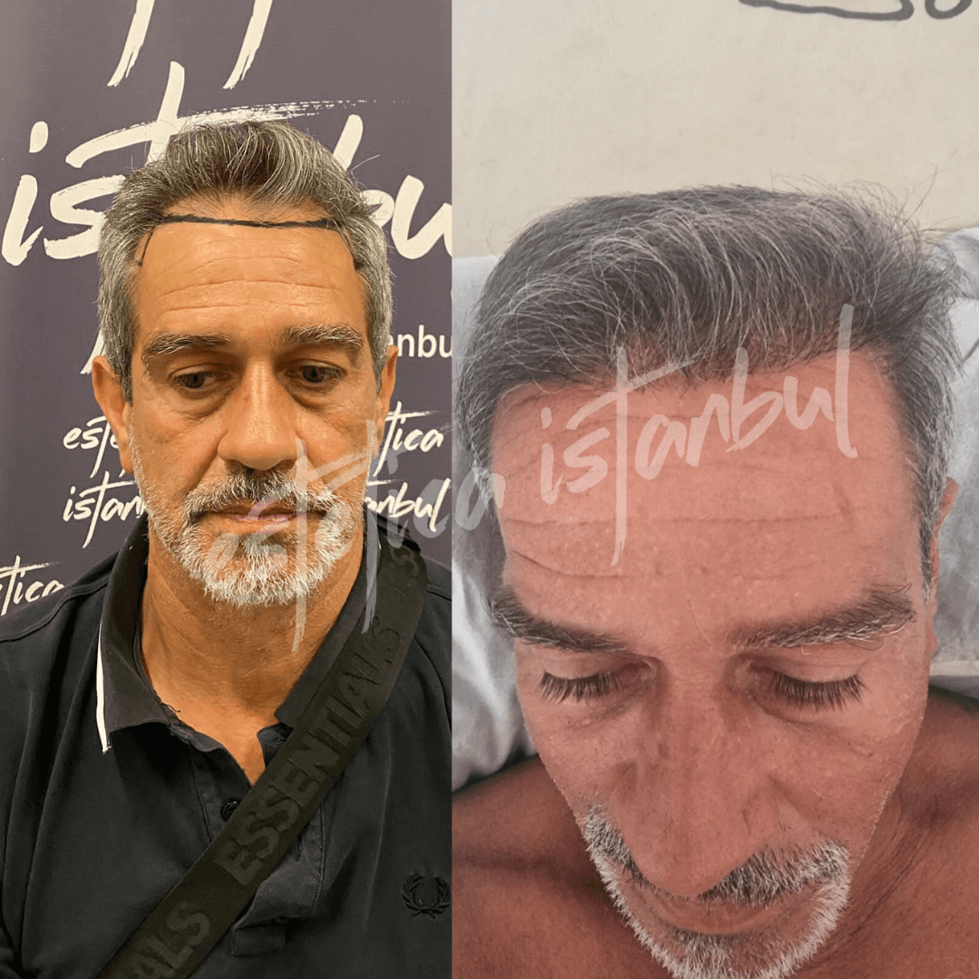 hair transplant in turkey before and after Turkey