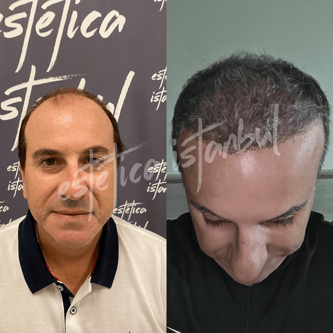 turkey hair transplant before and after