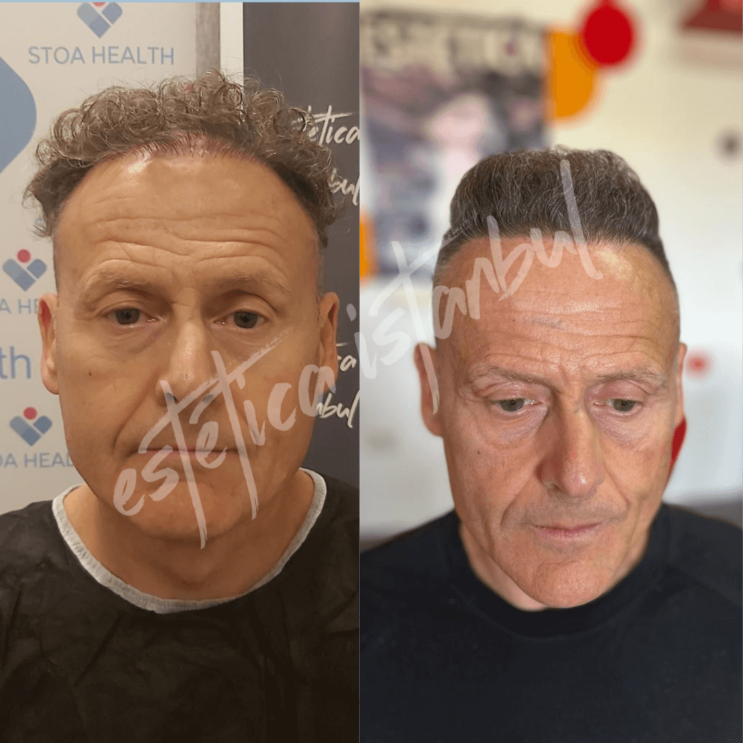 3500 grafts hair transplant before and after