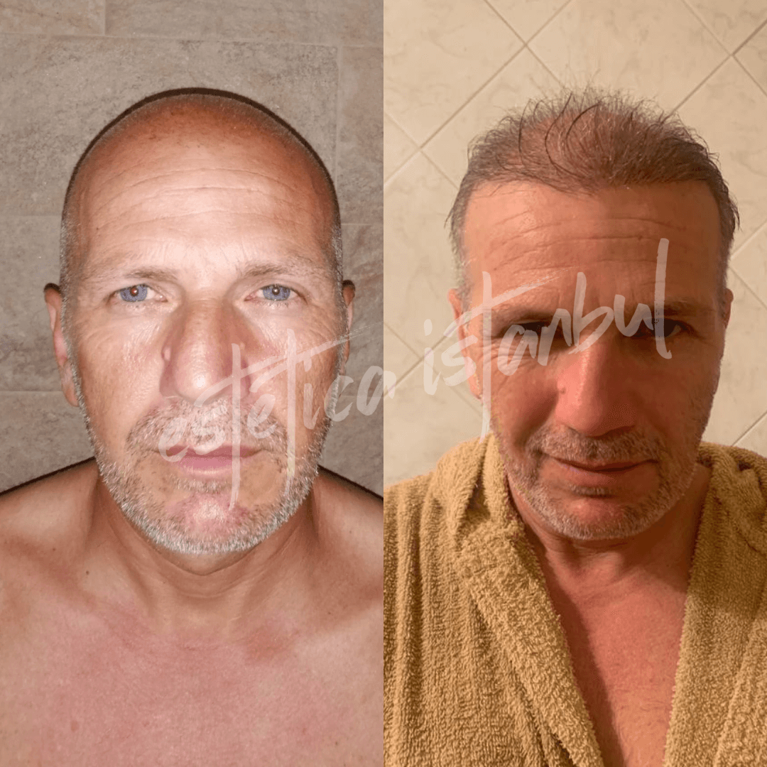 before after hair transplant Turkey
