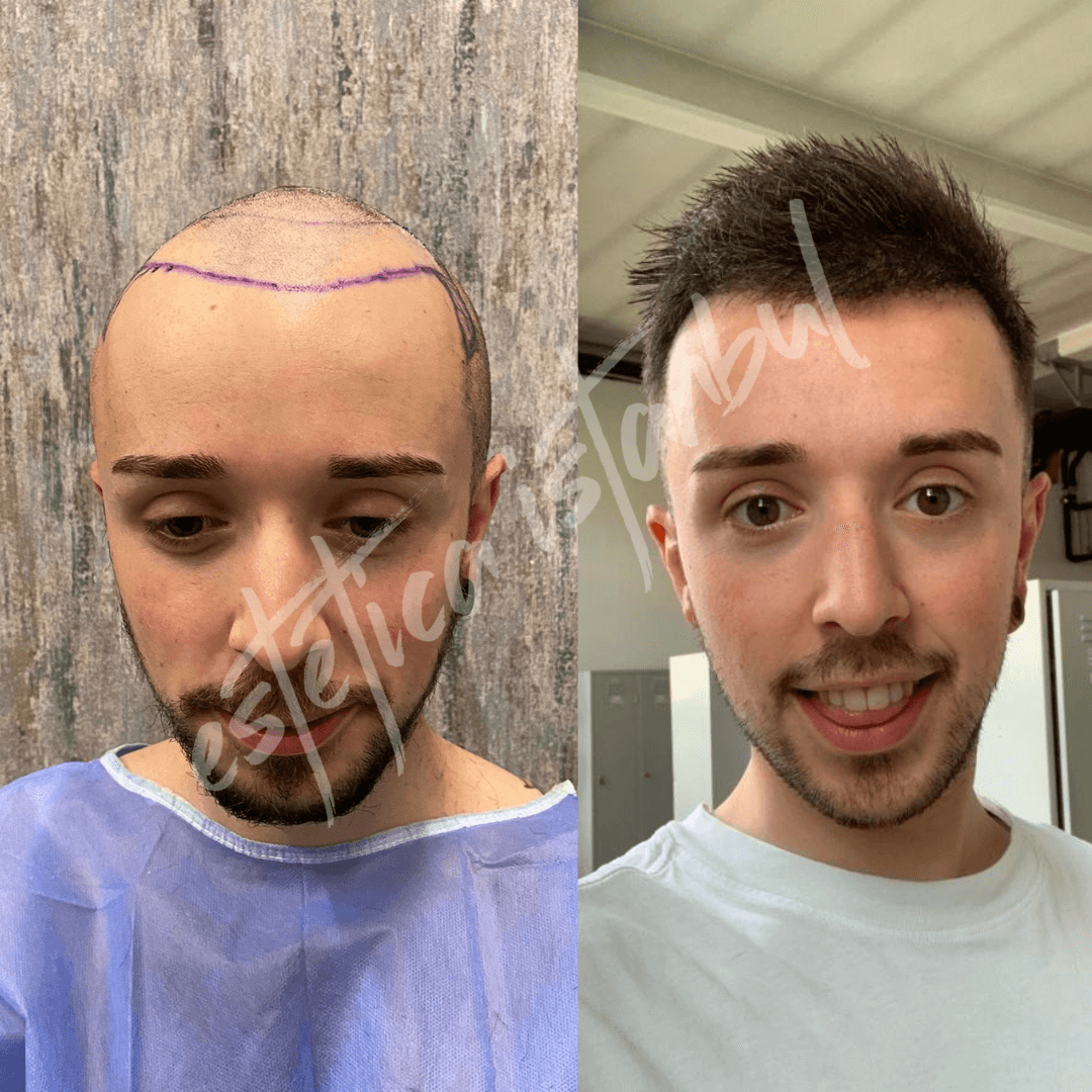 hair transplant before and after men