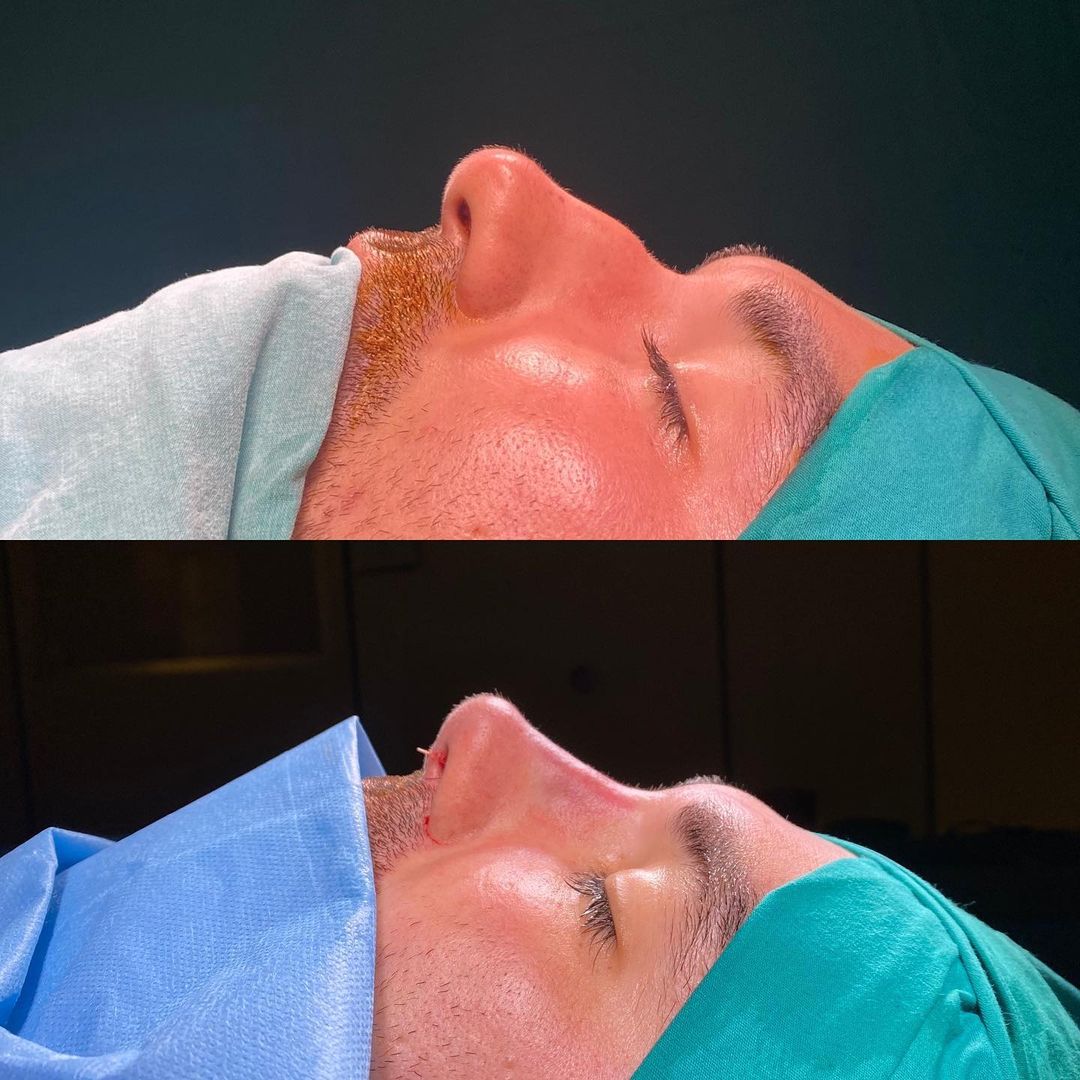 male rhinoplasty before and after Turkey
