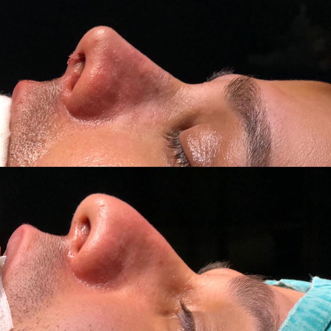 men rhinoplasty before and after Turkey