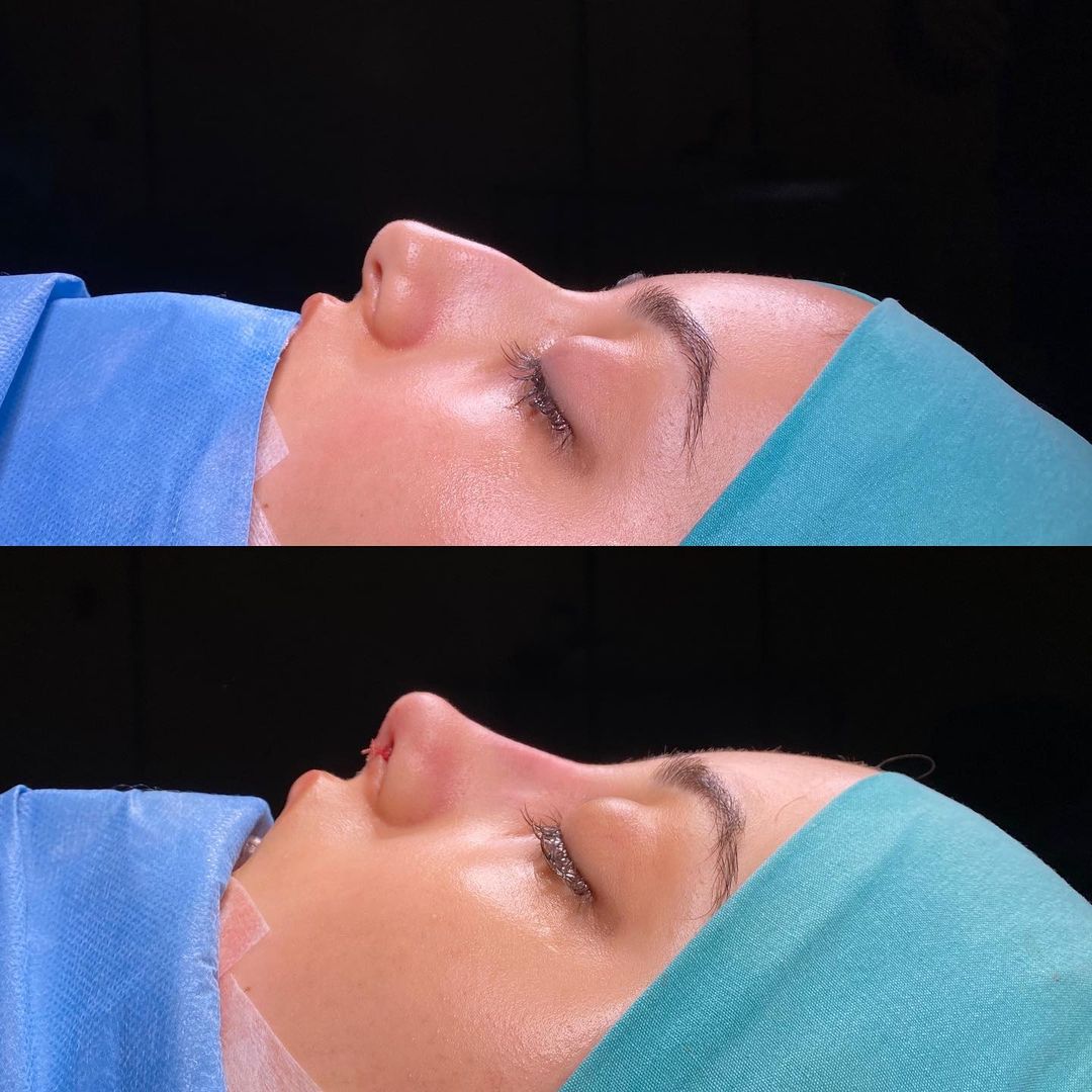 rhinoplasty before and after female Turkey