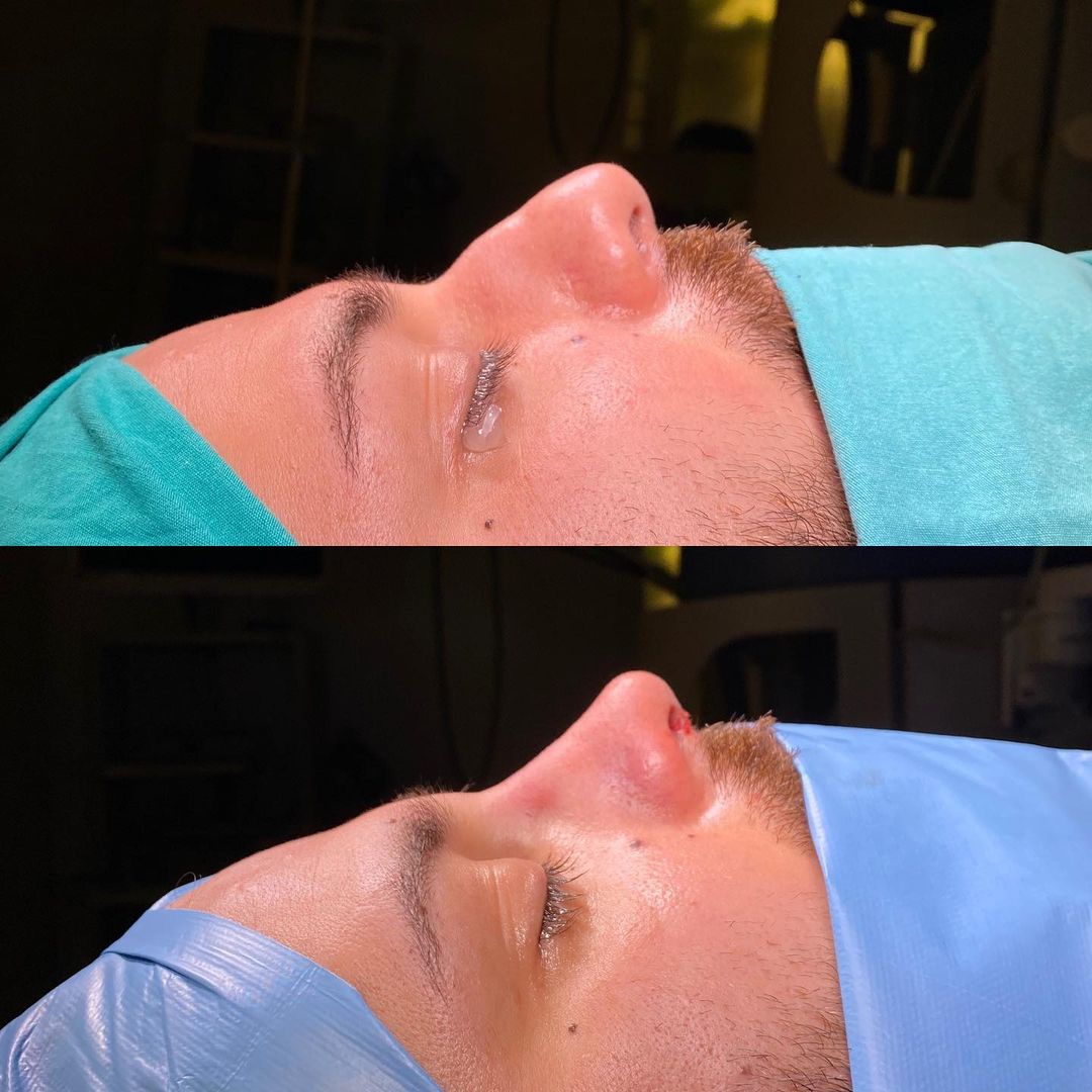 before and after rhinoplasty men