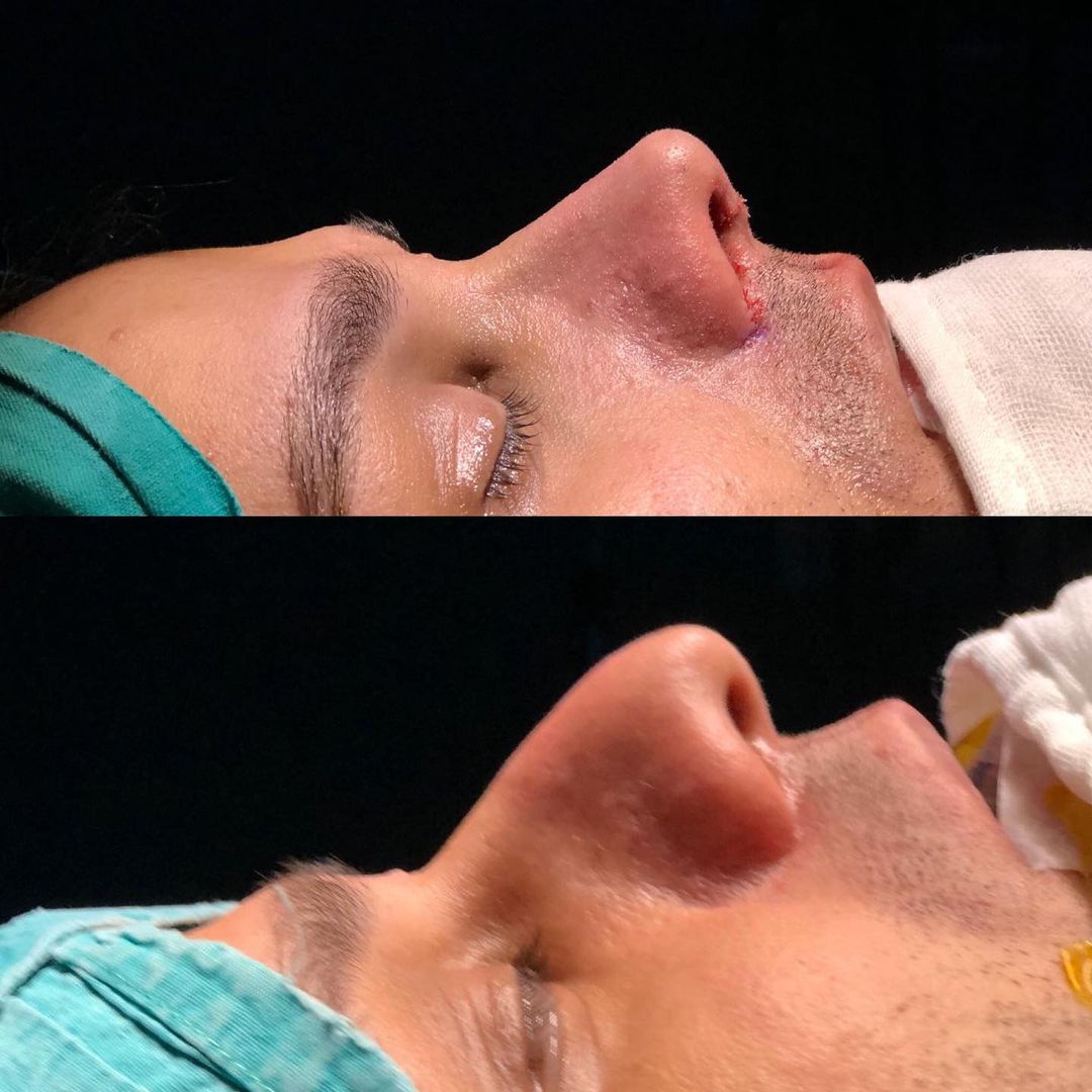 men rhinoplasty before and after