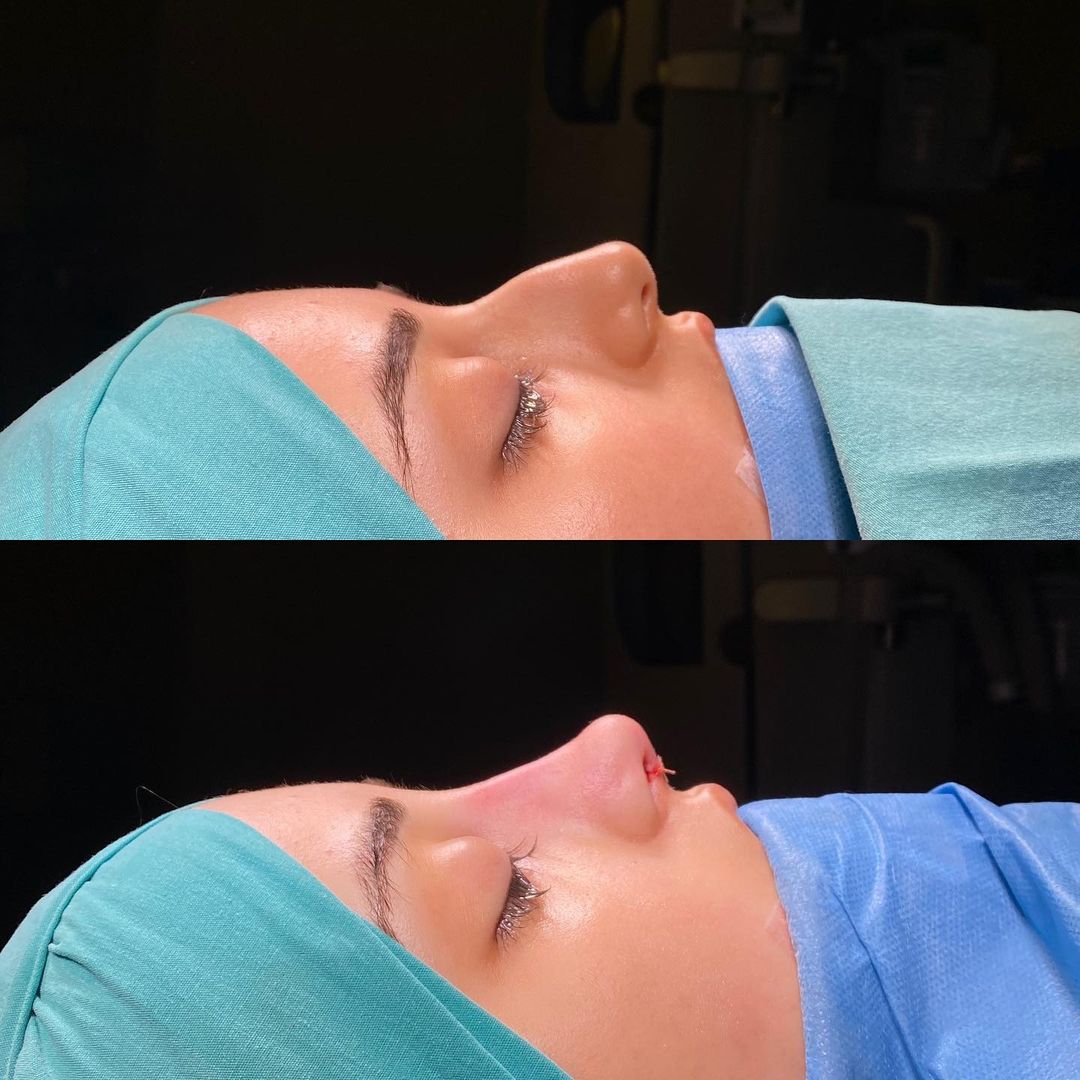 rhinoplasty before and after female