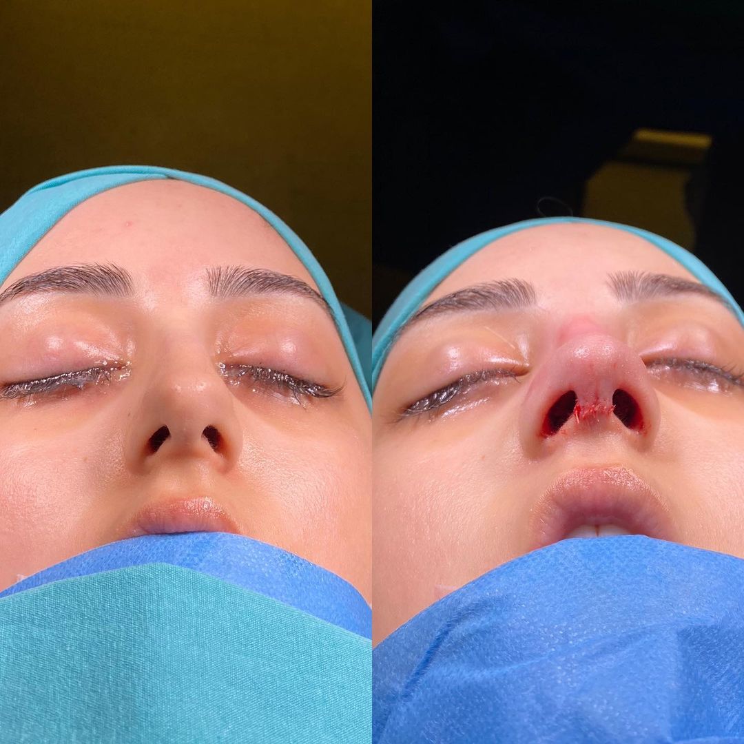 rhinoplasty before and after female in Turkey