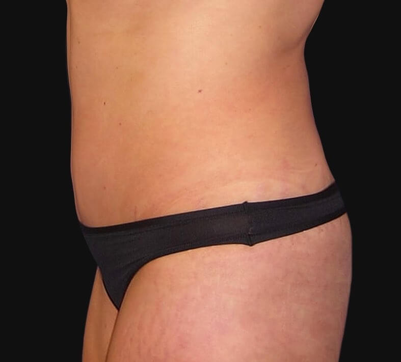 tummy tuck turkey before and after