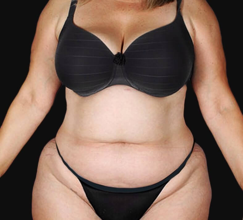 tummy tuck before after