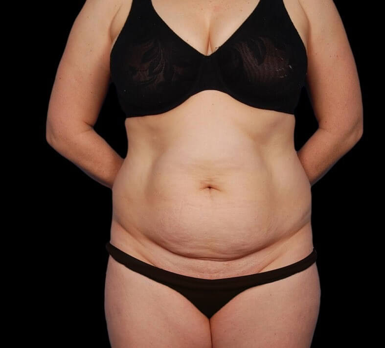 tummy tuck before and after pictures