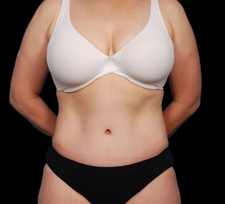 tummy tuck photos before and after in turkey