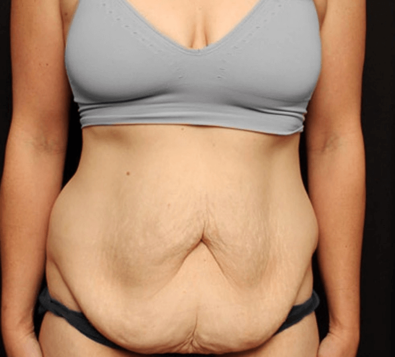 tummy tuck before and after female photos Turkey