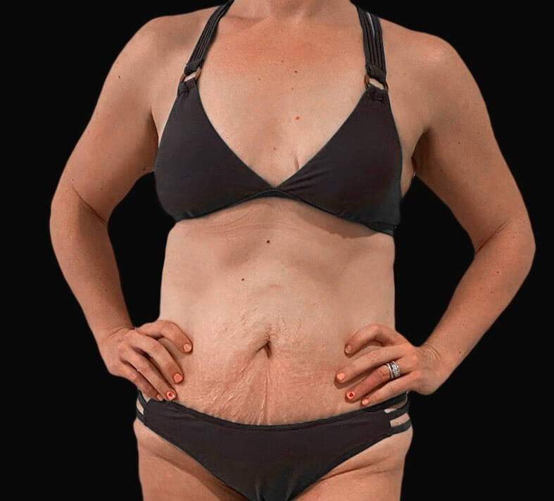 tummy tuck before and after female photos