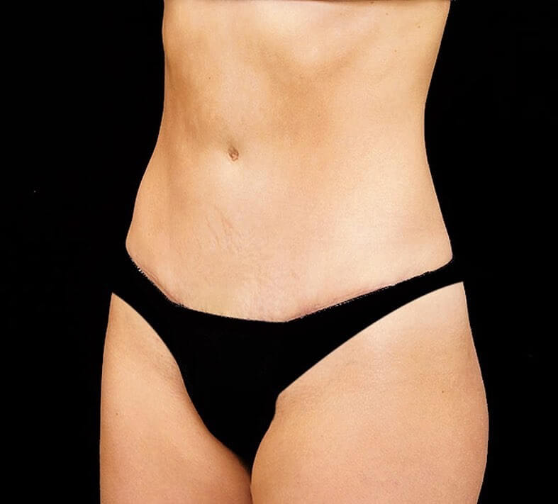 tummy tuck before and after female