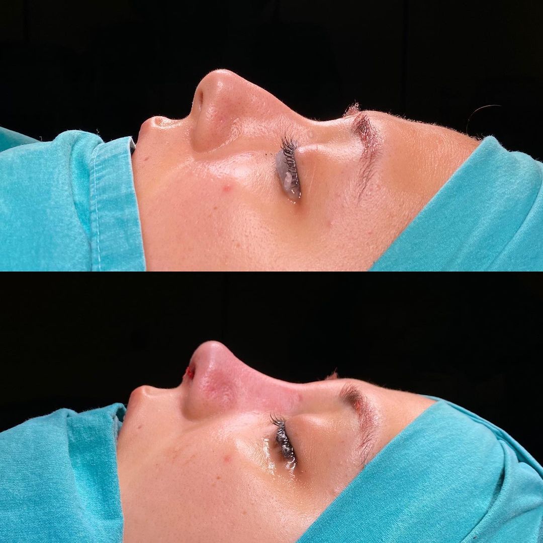 rhinoplasty before and after Turkey