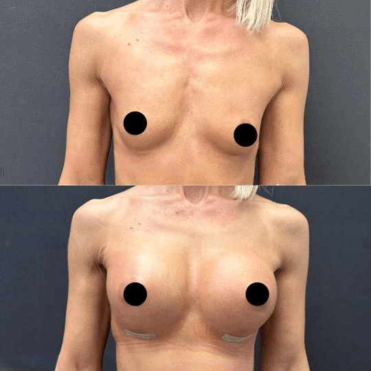 breast augmentation before and after photos in Turkey