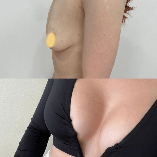 before and after breast augmentation photos Turkey