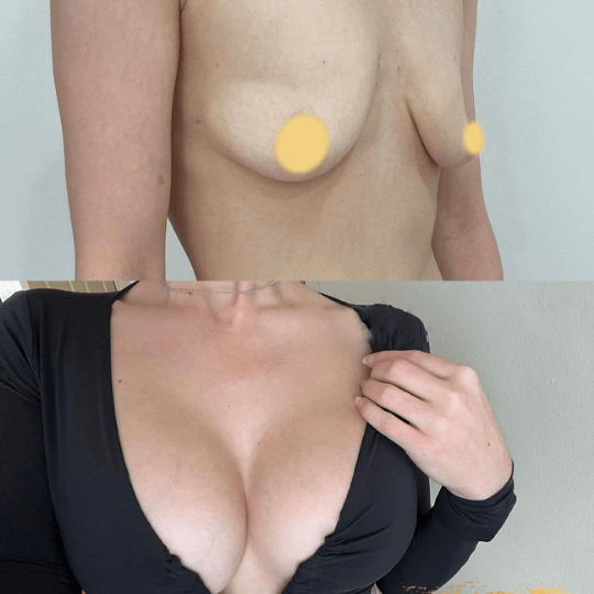 before and after breast augmentation photos in Turkey
