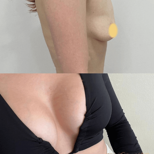 before and after breast augmentation photos
