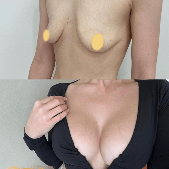 breast augmentation before and after pictures