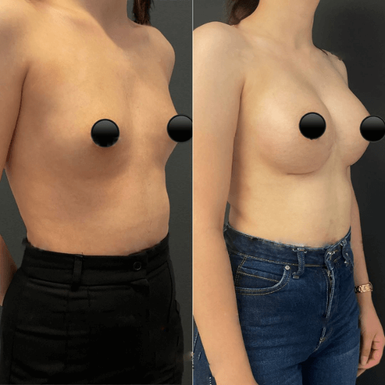 breast augmentation before and after pictures Turkey