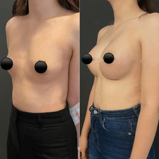 breast augmentation post op progress