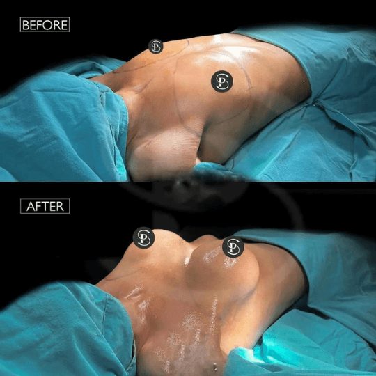 before after breast augmentation Turkey