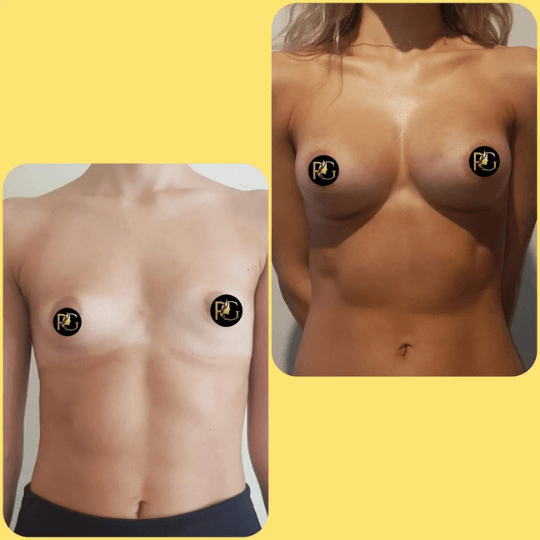 breast augmentation surgery before and after in Turkey
