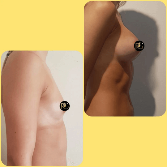 breast augmentation surgery before and after Turkey