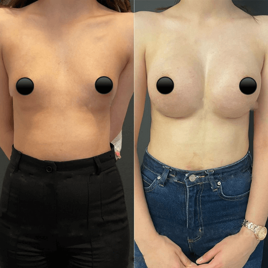 breast augmentation post op progress Turkey