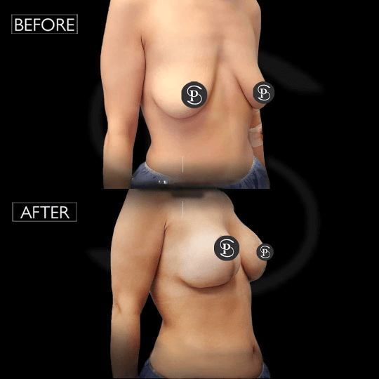 breast lift before after in Turkey