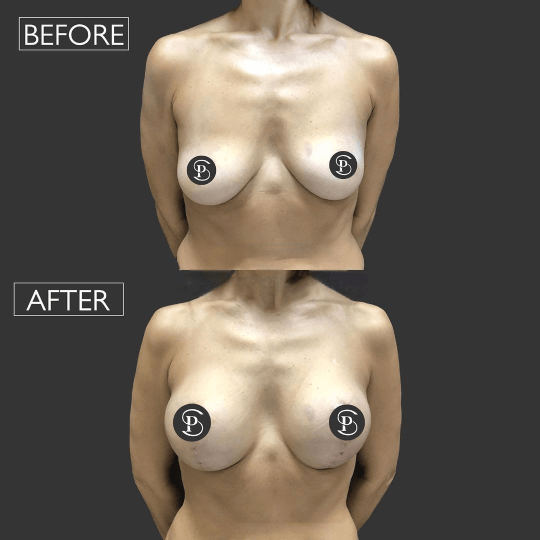 breast lift before and after Turkey