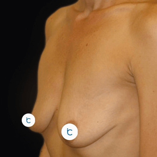 breast lift surgery before and after Turkey