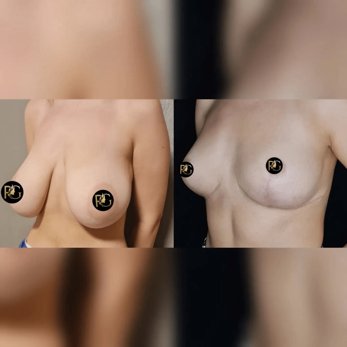 breast reduction before and after Turkey