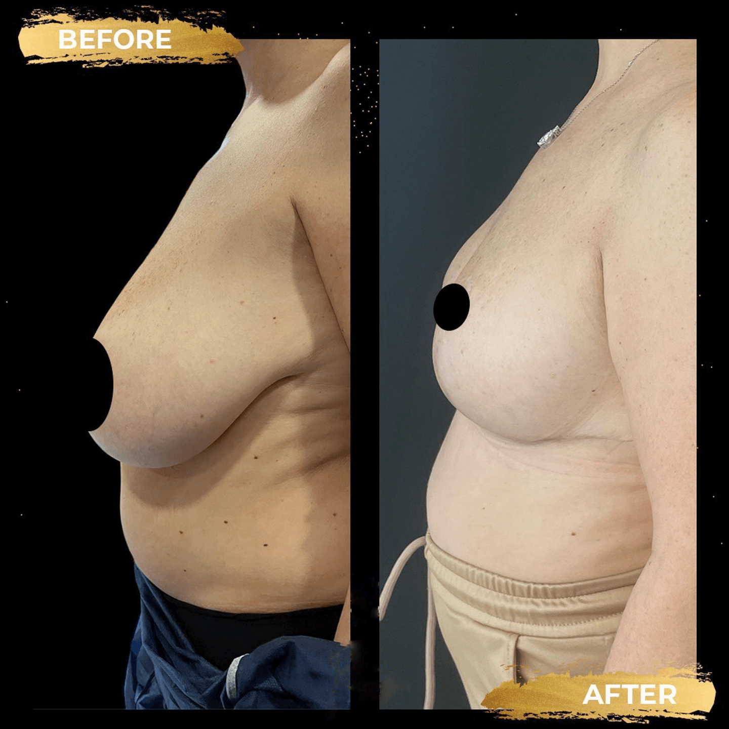 before and after breast reduction Turkey