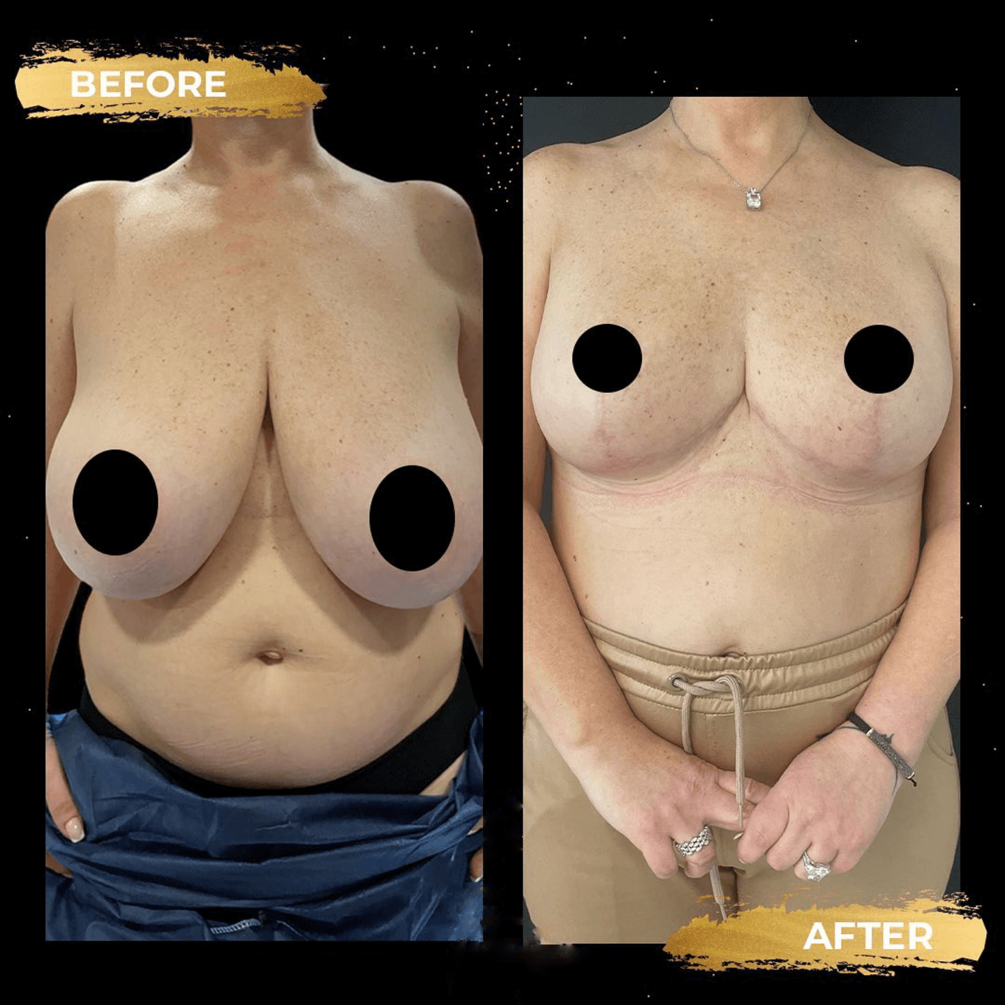 before and after breast reduction in Turkey