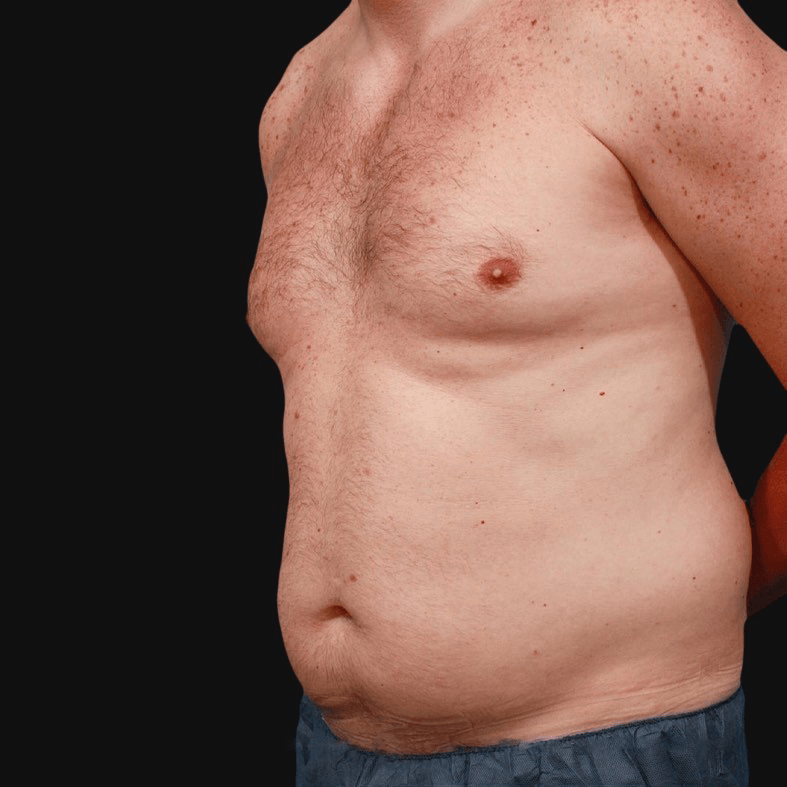 liposuction before and after men